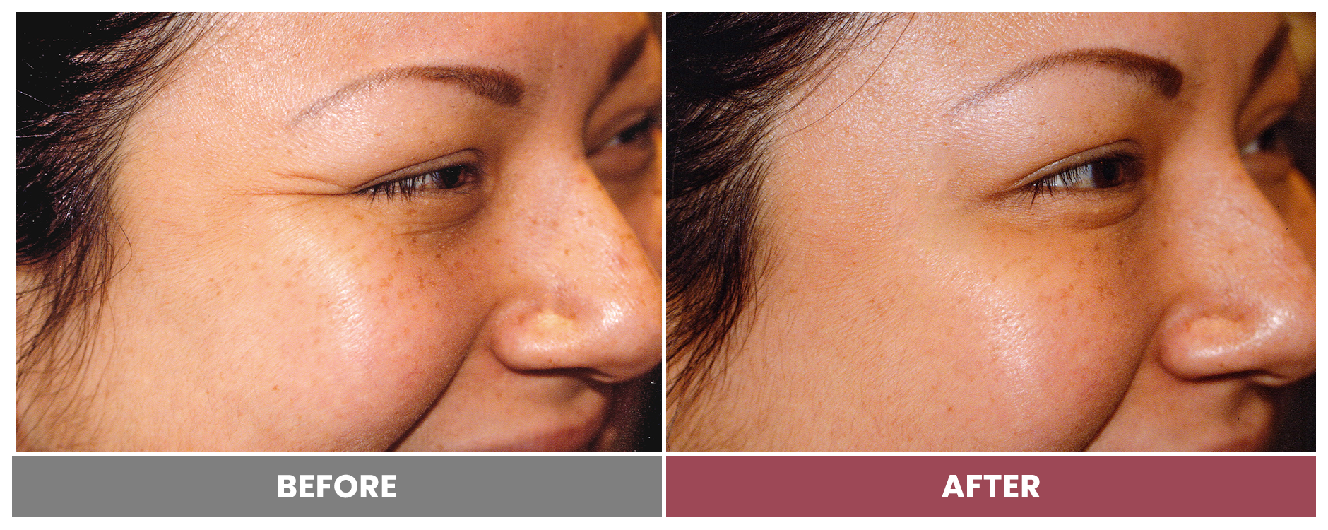 BOTOX FOR WRINKLES & BROW LIFT - Case 19